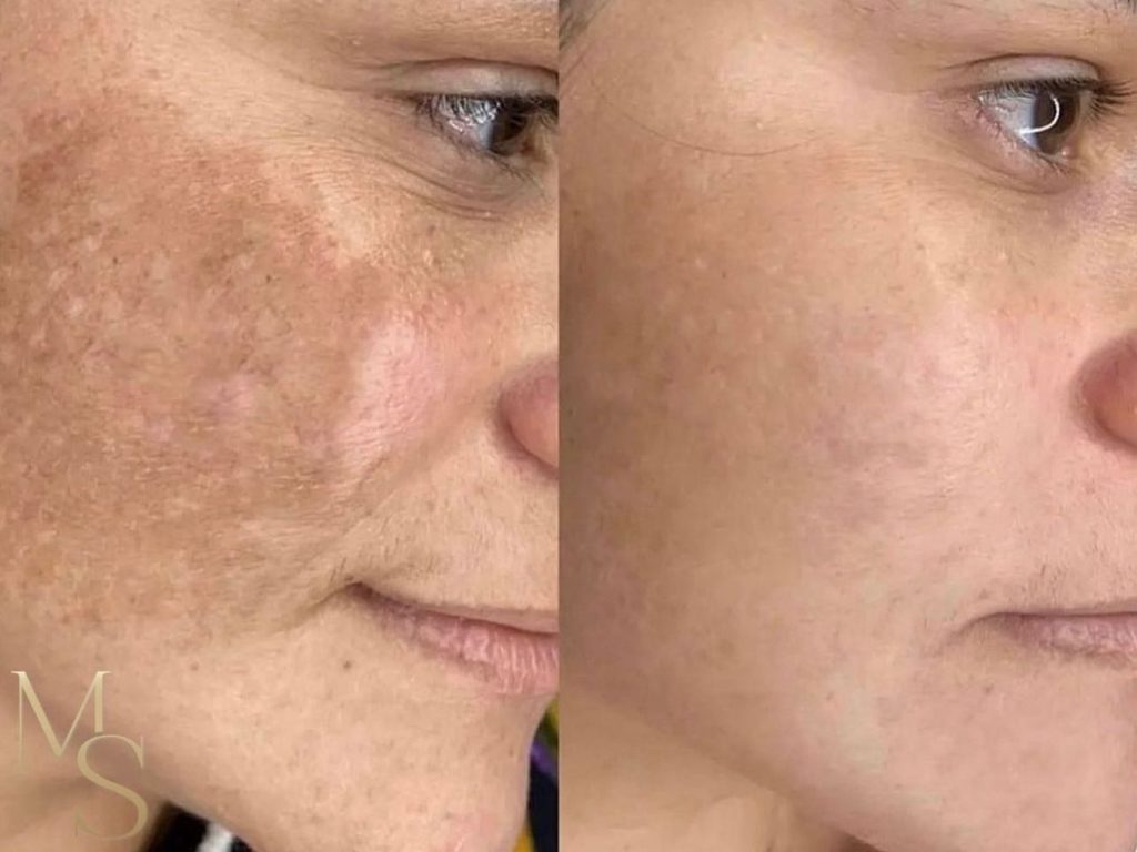 Melasma Treeatment with Dermamelan